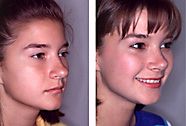 Plastic surgery (cosmetic surgery) before and after photograph