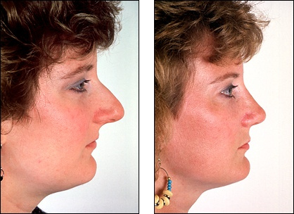 rhinoplasty projecting nose bump bridge long nose